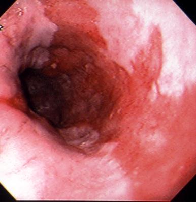 Figure 10. Endoscopic appearance of Barrett's esophagus. Note that broad tongues of columnar-type epithelium extend up from the gastroesophageal junction into the esophageal body that is normally lined with squamous epithelium. Histology reveals an intestinal-type metaplasia with goblet cells.