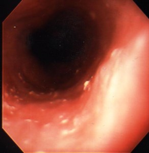 Endoscopic appearance of Candida esophagitis. Note the small white plaques adherent to the esophageal mucosa.