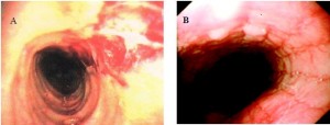 Figure 12. Endoscopic features of eosinophilic esophagitis. A) Note transverse ridges (“trachealization”) and mucosal trauma (top right). The latter is caused by trauma from passage of the endoscope, due to mucosal fragility and subtle luminal narrowing. B) Longitudinal furrowing and corrugation.