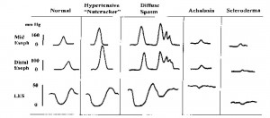 Figure 13. Schematic representation of manometric features of the major esophageal motor disorders.