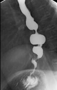 First Principles of Gastroenterology and Hepatology A. B. R. Thomson and E. A. Shaffer Figure 14. Barium contrast X-ray depicting a “Corkscrew” esophagus, typical of diffuse esophageal spasm. Simultaneous contractions at multiple sites along the esophagus create this pattern. A similar X-ray picture may be seen in vigorous achalasia, therefore manometry is required to firmly establish the diagnosis.