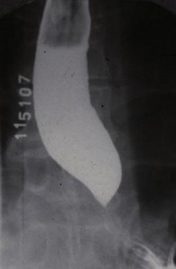 Figure 15. Typical barium x-ray in a patient with achalasia. Note that the esophagus is dilated and there is an air-barium meniscus indicative of stasis. At the gastroesophageal junction there is a beak-like narrowing, which is caused by the nonrelaxing LES. The mucosal contour at this narrow area appears normal, which helps distinguish this from a stricture caused by malignancy or reflux disease.