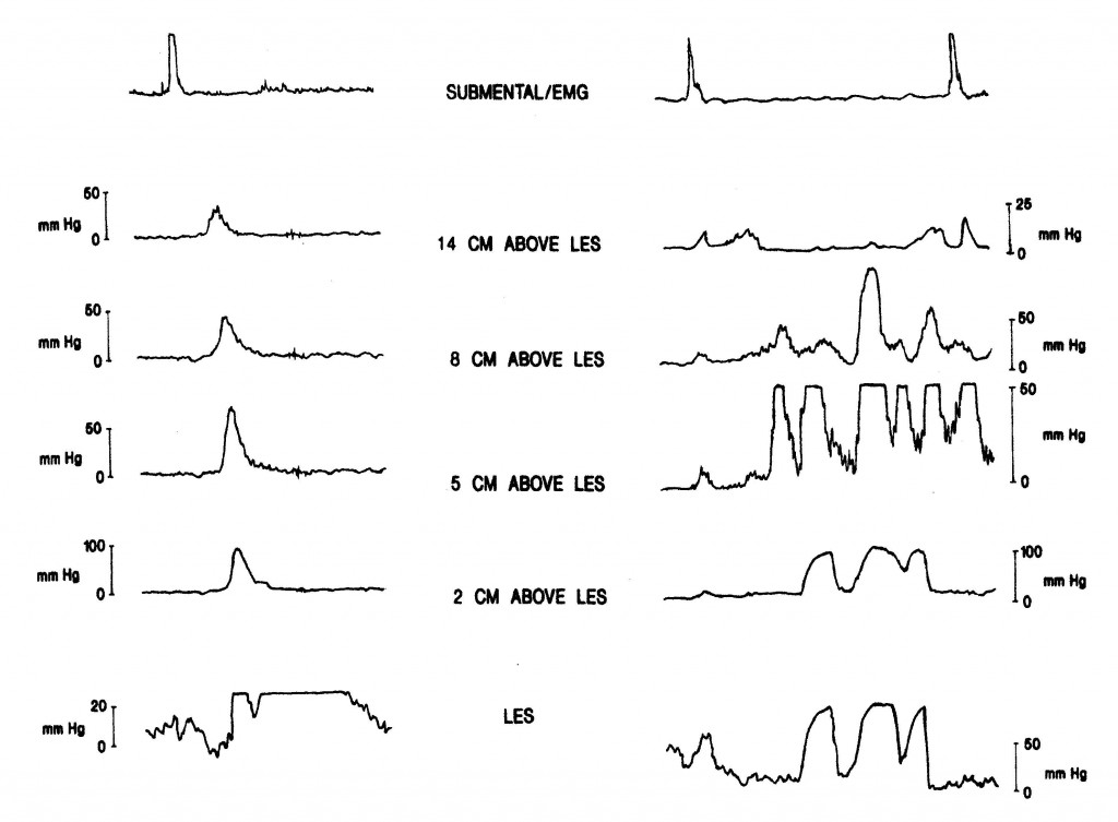 Figure 16. Example of esophageal manometry with provocative testing in a patient with angina-like chest pain and normal coronary angiography. The baseline tracing (left) is within normal limits. During acid perfusion (right) a pattern of diffuse esophageal spasm is induced, which coincided with the patient experiencing her typical angina-like pain. The patient also developed marked esophageal spasm with coincident pain following the injection of bethanechol (not shown). The top tracing is the submental electromyogram (EMG), which records the onset of deglutition. This is followed in sequence by intraluminal side hole pressure recordings from 14, 8, 5 and 2 cm above the lower esophageal sphincter (LES). The lowermost tracing is the pressure recorded by a pressure sensor straddling the LES. Source: Paterson WG, Marciano-D’Amore DA, Beck IT, et al. Esophageal manometry with provocative testing in patients with non-cardiac angina-like chest pain. Canadian Journal of Gastroenterology1991; 5(2):51–57. Reproduced with permission of the Canadian Journal of Gastroenterology.