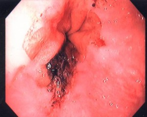 Figure 19. Endoscopic view of a Mallory-Weiss tear. Note the mucosal laceration with blood clot at its base at the gastroesophageal junction. Patients with this lesion typical have vigorous retching or vomiting before vomiting up fresh blood and/or passing melena.