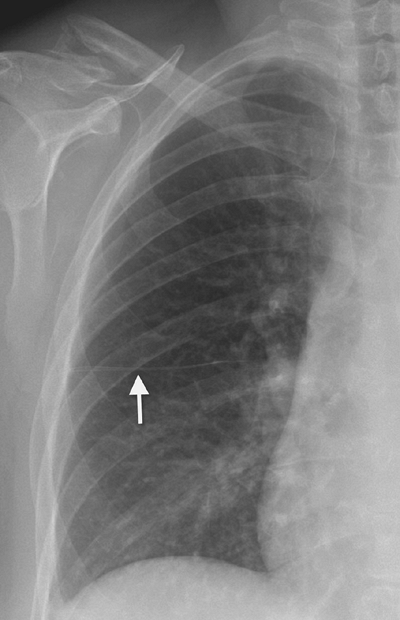 FIGURE 1-10. Minor fissure on PA chest radiograph. The minor fissure has a horizontal course from the right hilum to the periphery of the right lung (arrow).