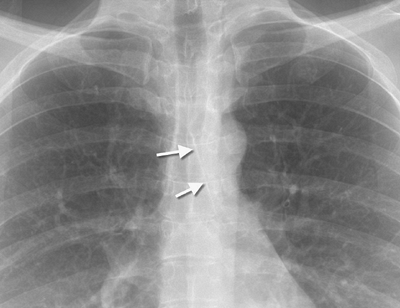 FIGURE 1-14. Anterior junction line on PA chest radiograph (arrows). Note that the line does not extend above the level of the clavicles.