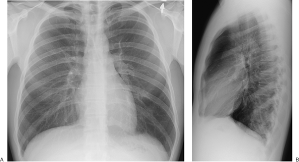 FIGURE 1-2. Normal PA (A) and lateral (B) chest radiographs, showing the structures numbered and labeled in Figure 1-1.