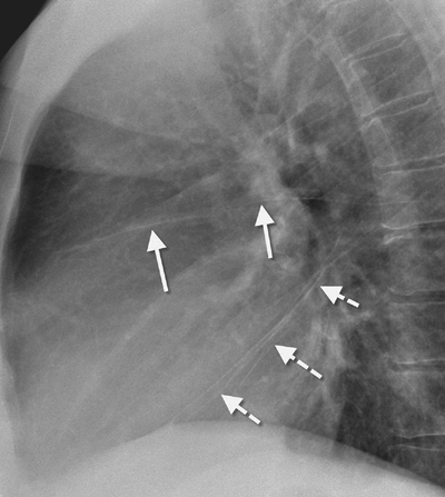 FIGURE 1-9. Major and minor fissures on lateral chest radiograph. The inferior portions of the major fissures (dashed white arrows) and the right minor fissure (solid white arrows) are shown. They outline the location of the right middle lobe. The superior portions of the major fissures are not well seen. It is not uncommon that portions of the fissures are not visualized on normal chest radiographs.